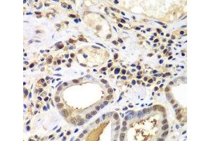 Immunohistochemistry of paraffin-embedded Human gastric cancer using PSME2 Polyclonal Antibody at dilution of 1:100 (40x lens). (PSME2 anticorps)