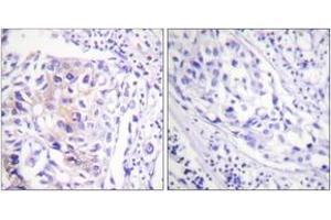 Immunohistochemistry analysis of paraffin-embedded human breast carcinoma, using CBL (Phospho-Tyr774) Antibody. (CBL anticorps  (pTyr774))
