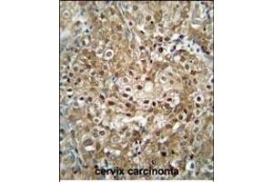 C antibody (C-term) (ABIN654740 and ABIN2844426) immunohistochemistry analysis in formalin fixed and paraffin embedded human cervix carcinoma followed by peroxidase conjugation of the secondary antibody and DAB staining. (CF153 (AA 230-259), (C-Term) anticorps)
