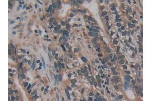 Detection of AATK in Human Stomach cancer Tissue using Polyclonal Antibody to Apoptosis Associated Tyrosine Kinase (AATK)