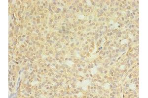 Immunohistochemistry of paraffin-embedded human breast cancer using ABIN7148714 at dilution of 1:100 (CTP Synthase anticorps  (AA 300-554))