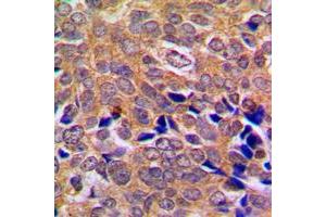 Immunohistochemical analysis of ABL1/2 staining in human breast cancer formalin fixed paraffin embedded tissue section. (ABL1/2 anticorps  (C-Term))