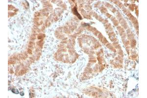 Formalin-fixed, paraffin-embedded human colon carcinoma stained with AKT1 Recombinant Mouse Monoclonal Antibody (rAKT1/2491). (Recombinant AKT1 anticorps  (AA 85-189))