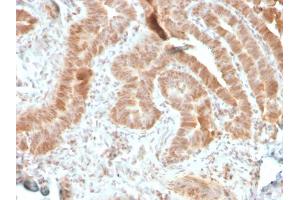 Formalin-fixed, paraffin-embedded human colon carcinoma stained with AKT1 Recombinant Mouse Monoclonal Antibody (rAKT1/2491).