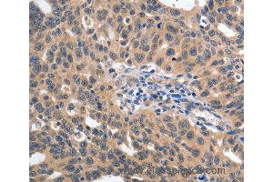 Immunohistochemistry of Human ovarian cancer using YWHAE Polyclonal Antibody at dilution of 1:60