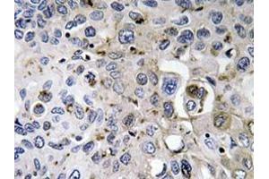 Immunohistochemistry analyzes of PDGF-A antibody in paraffin-embedded human lung carcinoma tissue. (PDGFA anticorps)