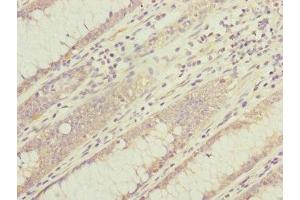 Immunohistochemistry of paraffin-embedded human colon cancer using ABIN7149316 at dilution of 1:100 (DYNC1I1 anticorps  (AA 1-220))