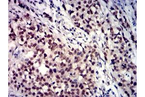 Immunohistochemical analysis of paraffin-embedded bladder cancer tissues using TBP mouse mAb with DAB staining. (TBP anticorps  (AA 1-144))