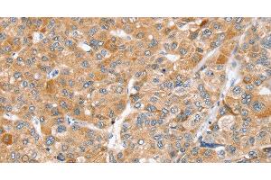 Immunohistochemistry of paraffin-embedded Human liver cancer using ZFP36L2 Polyclonal Antibody at dilution of 1:45