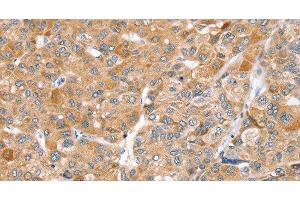 Immunohistochemistry of paraffin-embedded Human liver cancer using ZFP36L2 Polyclonal Antibody at dilution of 1:45 (ZFP36L2 anticorps)
