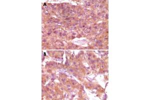 Immunohistochemical analysis of paraffin-embedded human skin carcinoma (A) and breast carcinoma (B), showing cytoplasmic and membrane localization using SRA1 monoclonal antibody, clone 1D4H8  with DAB staining.