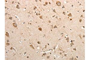The image on the left is immunohistochemistry of paraffin-embedded Human brain tissue using ABIN7131078(SLC12A1 Antibody) at dilution 1/15, on the right is treated with fusion protein. (SLC12A1 anticorps)