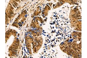 ABIN6258686 and ABIN6274922 at 1/100 staining Human colorectal cancer by IHC-P. (FAM203B anticorps  (Internal Region))