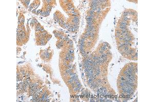Immunohistochemistry of Human breast cancer using PARD6A Polyclonal Antibody at dilution of 1:60