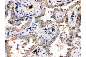 Anti- ULK3 Picoband antibody, IHC(P) IHC(P): Human Lung Cancer Tissue (ULK3 anticorps  (C-Term))