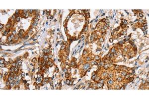 Immunohistochemistry of paraffin-embedded Human liver cancer tissue using SLC5A11 Polyclonal Antibody at dilution 1:35 (Solute Carrier Family 5 (Sodium/inositol Cotransporter), Member 11 (SLC5A11) anticorps)
