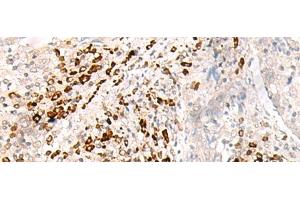 Immunohistochemistry of paraffin-embedded Human cervical cancer tissue using HLA-B Polyclonal Antibody at dilution of 1:30(x200) (HLA-B anticorps)