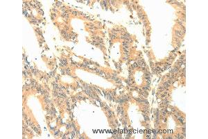Immunohistochemistry of Human colon cancer using PTGES3 Polyclonal Antibody at dilution of 1:50 (CDK5R1 anticorps)