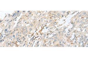 Immunohistochemistry of paraffin-embedded Human cervical cancer tissue using TPMT Polyclonal Antibody at dilution of 1:60(x200) (TPMT anticorps)