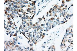 Immunohistochemical staining of paraffin-embedded Adenocarcinoma of Human colon tissue using anti-IGF2BP2 mouse monoclonal antibody. (IGF2BP2 anticorps)