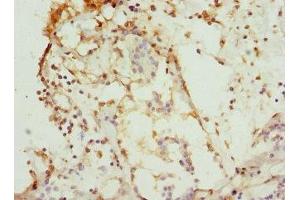 Immunohistochemistry of paraffin-embedded human breast cancer using ABIN7146875 at dilution of 1:100 (CSNK1G1 anticorps  (Isoform gamma 1))