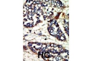 Formalin-fixed and paraffin-embedded human cancer tissue reacted with the primary antibody, which was peroxidase-conjugated to the secondary antibody, followed by DAB staining.