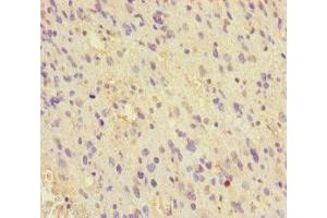 Immunohistochemistry of paraffin-embedded human glioma using ABIN7159738 at dilution of 1:100