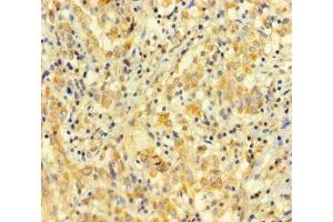 Immunohistochemistry of paraffin-embedded human lung cancer using ABIN7167948 at dilution of 1:100 (ARHGAP27 anticorps  (AA 1-300))