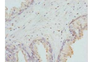 Immunohistochemistry of paraffin-embedded human prostate cancer using ABIN7155677 at dilution of 1:100 (DLX2 anticorps  (AA 1-140))