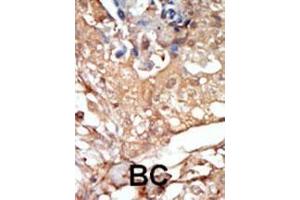 Formalin-fixed and paraffin-embedded human cancer tissue reacted with the primary antibody, which was peroxidase-conjugated to the secondary antibody, followed by DAB staining.