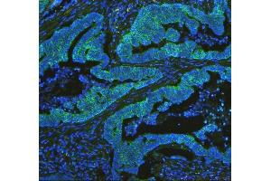 IF analysis of Cytochrome C using anti-Cytochrome C antibody (ABIN3042783) Cytochrome C was detected in paraffin-embedded section of human intestinal cancer tissues.