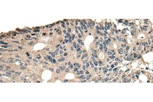 Immunohistochemistry of paraffin-embedded Human colorectal cancer tissue using SLAMF7 Polyclonal Antibody at dilution of 1:30(x200)