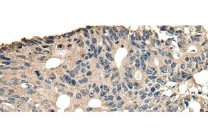 Immunohistochemistry of paraffin-embedded Human colorectal cancer tissue using SLAMF7 Polyclonal Antibody at dilution of 1:30(x200) (SLAMF7 anticorps)