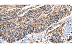 Immunohistochemistry of paraffin-embedded Human esophagus cancer tissue using EFNB2 Polyclonal Antibody at dilution 1:80 (Ephrin B2 anticorps)