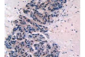 IHC-P analysis of Human Breast Cancer Tissue, with DAB staining. (Endoglin anticorps  (AA 26-136))