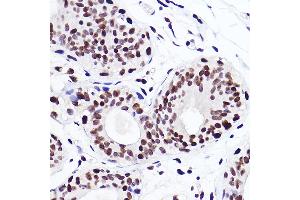Immunohistochemistry of paraffin-embedded human breast cancer using MonoMethyl-Histone H3-K18 Rabbit mAb (ABIN7267683) at dilution of 1:100 (40x lens).