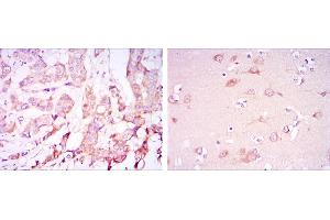 Immunohistochemical analysis of paraffin-embedded breast cancer tissues (left) and brain tissues (right) using PDK1 mouse mAb with DAB staining.