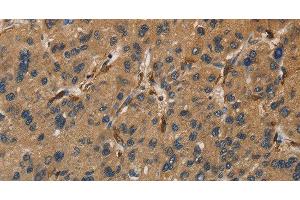 Immunohistochemistry of paraffin-embedded Human liver cancer tissue using UBE2S Polyclonal Antibody at dilution 1:40