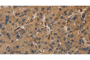 Immunohistochemistry of paraffin-embedded Human liver cancer tissue using UBE2S Polyclonal Antibody at dilution 1:40 (UBE2S anticorps)