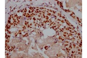 IHC image of ABIN7127596 diluted at 1:100 and staining in paraffin-embedded human breast cancer performed on a Leica BondTM system.
