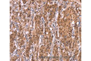 Immunohistochemistry of Human thyroid cancer using AMER1 Polyclonal Antibody at dilution of 1:40 (WTX anticorps)