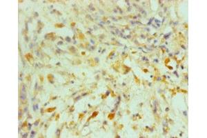 Immunohistochemistry of paraffin-embedded human melanoma using ABIN7164069 at dilution of 1:100 (OCT4 anticorps  (AA 1-360))