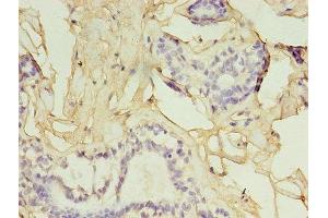 Immunohistochemistry of paraffin-embedded human breast cancer using ABIN7153819 at dilution of 1:100 (GGPS1 anticorps  (AA 1-300))