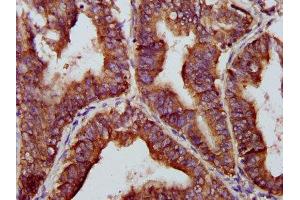 IHC image of ABIN7145788 diluted at 1:200 and staining in paraffin-embedded human endometrial cancer performed on a Leica BondTM system.