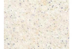 ABIN6263846 and ABIN6272717 at 1/100 staining human astrocytoma by IHC-P.