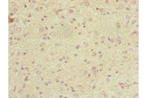 Immunohistochemistry of paraffin-embedded human glioma using ABIN7149326 at dilution of 1:100