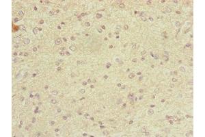 Immunohistochemistry of paraffin-embedded human glioma using ABIN7149326 at dilution of 1:100 (DYNC2LI1 anticorps  (AA 1-352))