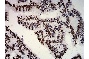 Immunohistochemical analysis of paraffin-embedded colon cancer tissues using ESR1 mouse mAb with DAB staining. (Estrogen Receptor alpha anticorps  (AA 2-185))