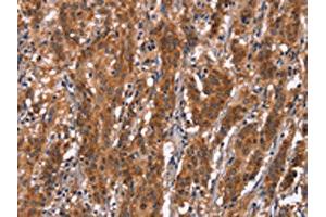 The image on the left is immunohistochemistry of paraffin-embedded Human gastric cancer tissue using ABIN7190842(GPHN Antibody) at dilution 1/30, on the right is treated with synthetic peptide. (Gephyrin anticorps)