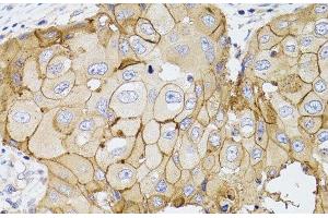 Immunohistochemistry of paraffin-embedded Human breast cancer using PDE4D Polyclonal Antibody at dilution of 1:100 (40x lens). (PDE4D anticorps)